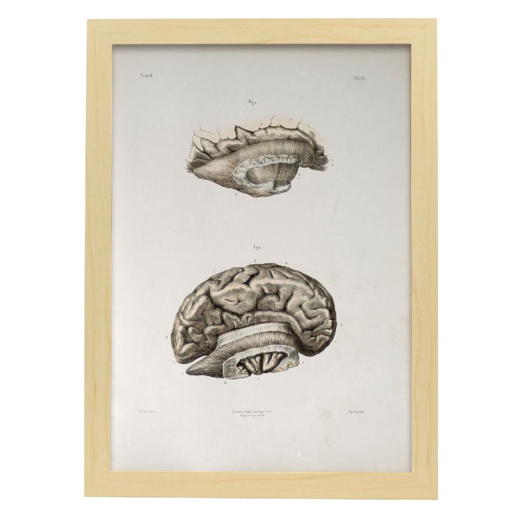 Nacnic Brain Divided In Parasagital Section