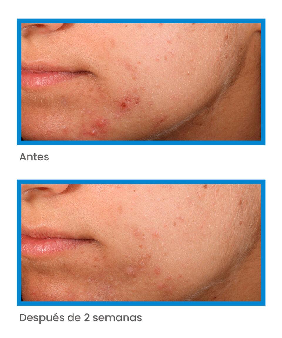 Murad Tratamiento Anti Imperfecciones Outsmart Blemish Clarifying 50 Ml