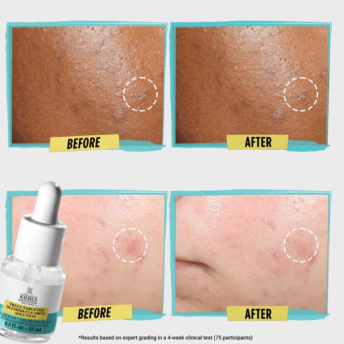 Kiehl's Since 1851 Truly Targeted Blemish - Clearing Solution