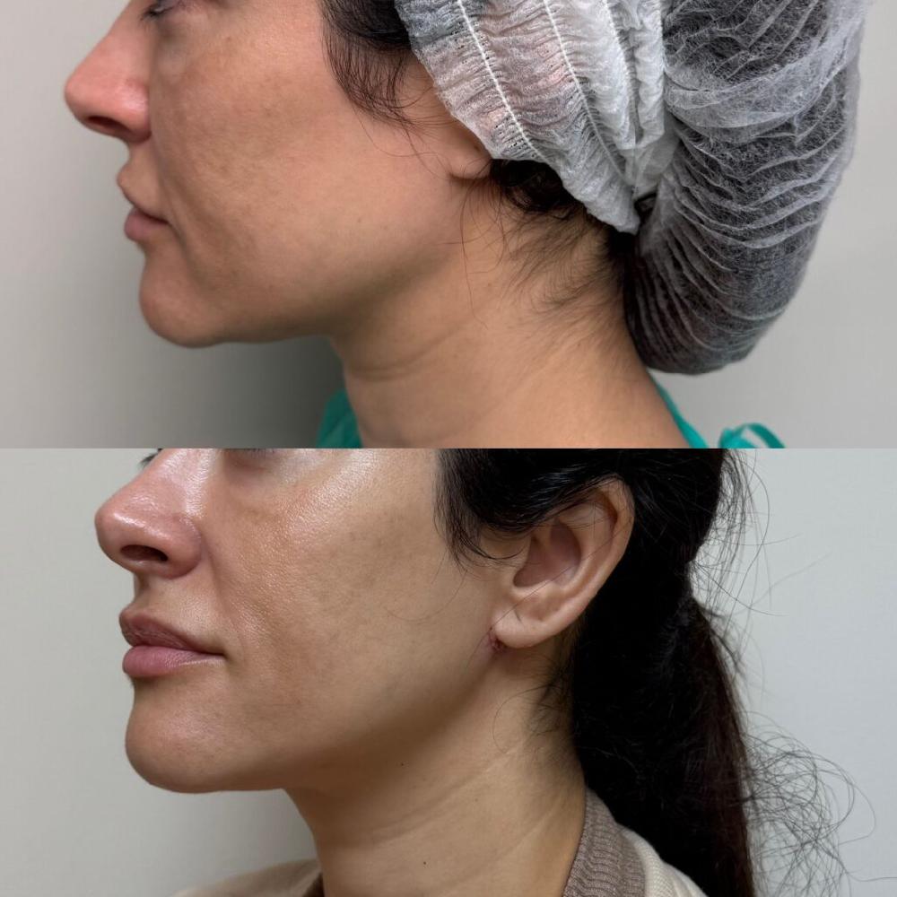 Mimub Microlifting: La Innovadora Técnica Estética Llega a España de la Mano del Dr. Albert Bosch