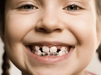 Mimub Ortodoncia Infantil: Ventajas y Tratamientos en el Centre Dental Francesc Macià